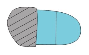 Compressible FF Post to Sulcus