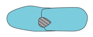 Neuroma Pad